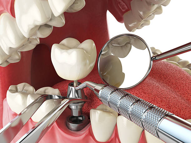 Best Emergency Dental Care for Abscessed Tooth in North Auburn, CA